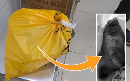 थैली में बहन का कटा पैर लेकर पहुंचा भाईः  एक्सीडेंट में 14 साल की लड़की का पैर कटकर सड़क पर गिरा; डॉक्टर बोले-जोड़ना संभव नहीं