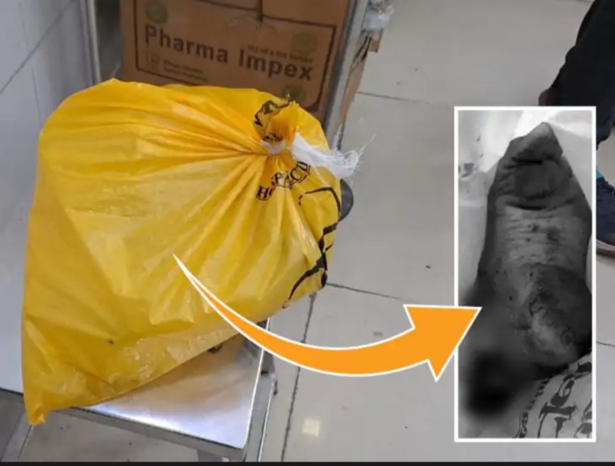 थैली में बहन का कटा पैर लेकर पहुंचा भाईः  एक्सीडेंट में 14 साल की लड़की का पैर कटकर सड़क पर गिरा; डॉक्टर बोले-जोड़ना संभव नहीं