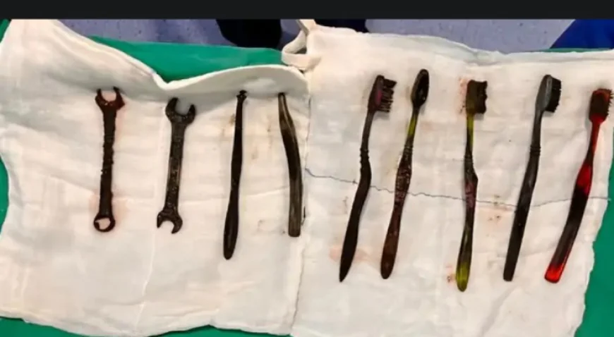 जयपुर में युवक के पेट से निकाले गए 7 टूथब्रश और 2 लोहे के पाने: डॉक्टर भी रह गए हैरान