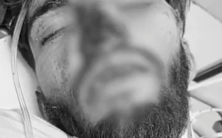 जोधपुर के लूणी में युवती भगाने के आरोपी युवक पर बेरहमी से हमला: नाक काटी, हाथ-पैर तोड़े