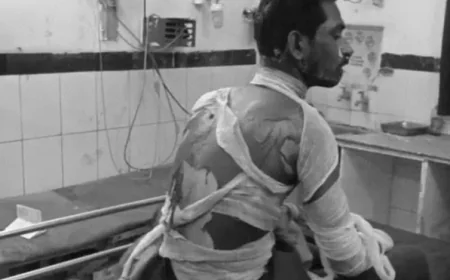 नए ऑटो रिक्शा की बार-बार खराबी से तंग आकर युवक ने खुद को लगा ली आग: 70% झुलसा, जोधपुर MDM हॉस्पिटल में भर्ती