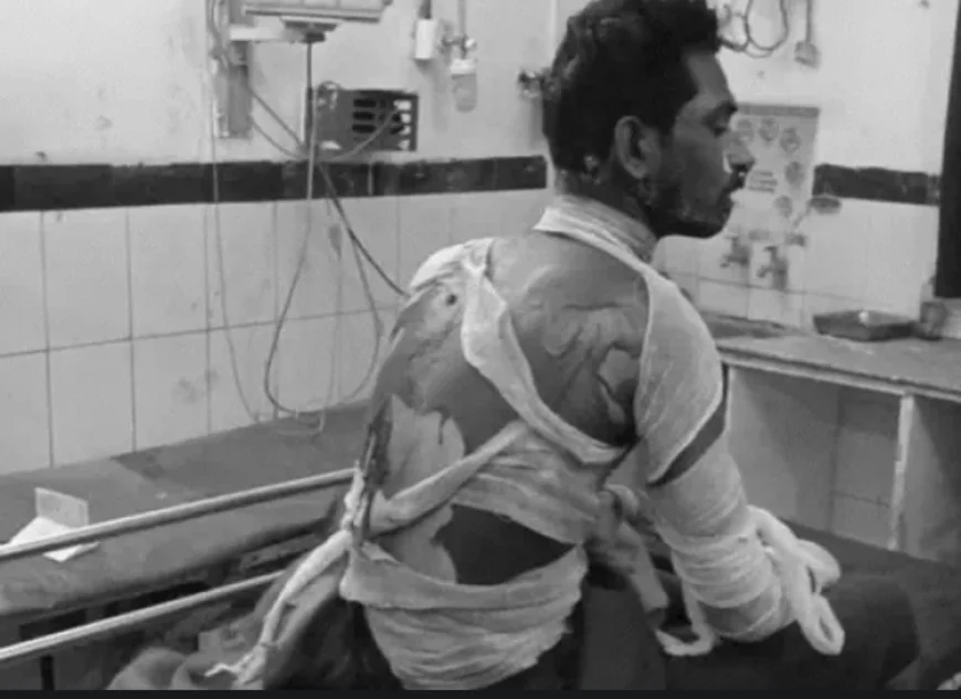नए ऑटो रिक्शा की बार-बार खराबी से तंग आकर युवक ने खुद को लगा ली आग: 70% झुलसा, जोधपुर MDM हॉस्पिटल में भर्ती