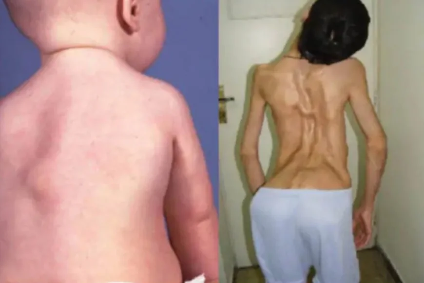 राजस्थान में 9 साल का बच्चा धीरे-धीरे 'पत्थर' बन रहा है: स्टोन मैन सिंड्रोम (FOP) का प्रदेश में पहला मामला, डॉक्टरों ने कहा - कोई स्थायी इलाज नहीं