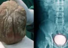 3 साल तक दर्द सहता रहा किसान, ब्लैडर से निकली 1.3 किलो की पथरी: डॉक्टर बोले- समय पर इलाज नहीं होता तो फेल हो सकती थी किडनी