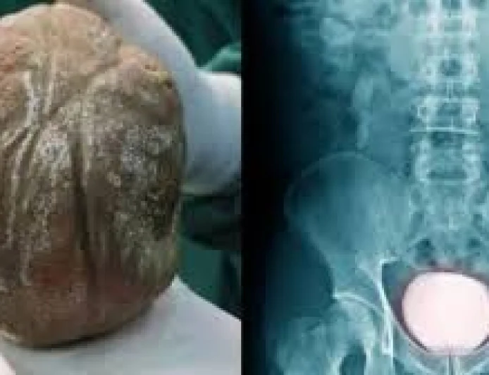 3 साल तक दर्द सहता रहा किसान, ब्लैडर से निकली 1.3 किलो की पथरी: डॉक्टर बोले- समय पर इलाज नहीं होता तो फेल हो सकती थी किडनी