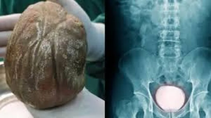 3 साल तक दर्द सहता रहा किसान, ब्लैडर से निकली 1.3 किलो की पथरी: डॉक्टर बोले- समय पर इलाज नहीं होता तो फेल हो सकती थी किडनी